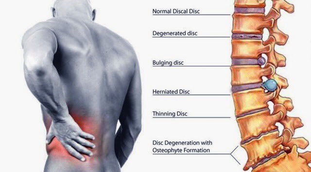 low back pain and neck pain