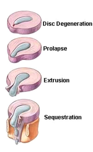 neck pain chiropractic