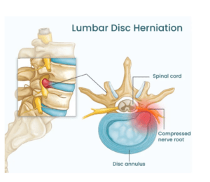 Lumbar spine and pelvis with lumbar nerves and piriformis muscle