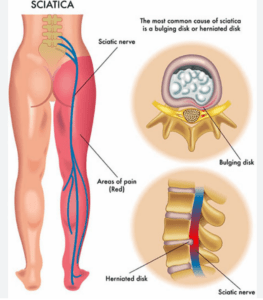 The sciatic nerve and a disc bulge causing pain down the leg