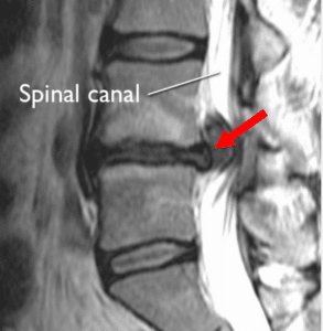 MRI of a lumbar disc bulge