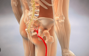 Sciatica
