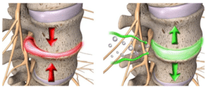 Lumbar spine intervertebral disc